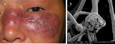 Unusual Parasitic And Fungal Infections Mucormycosis Rare Fungal