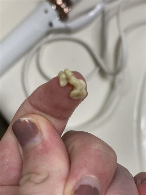 Large Bunch Of Tonsil Stones I Gently Pushed Out Last Night Rpopping