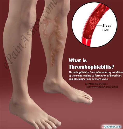 What Is Thrombophlebitis And How Can It Be Treated And Prevented