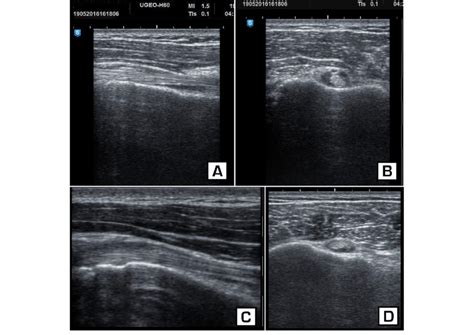 Ultrasound Image Of Biceps Brachii Tendon Biceps Tenosynovitis At