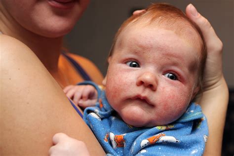 Baby Acne Causes Symptoms And Treatments