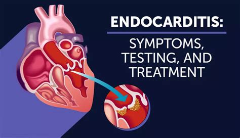 Endocarditis Symptoms Testing And Treatment Myheartdiseaseteam