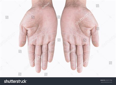 Two Male Palms Eczema Isolated On Stock Photo 252571750 Shutterstock