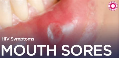 Aids Pictures Of Sores