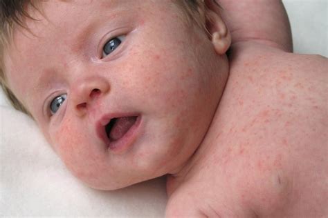 Sinais e sintomas de alergia alimentar no bebê Inc Seguros