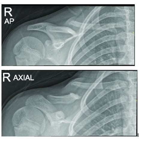 X Ray Showing Right Clavicle Pseudarthrosis With Demonstration Of
