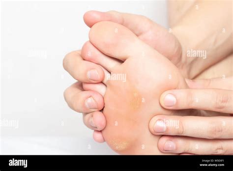 Man Shows Problem Skin On The Foot And Sole Of The Foot Dry And Callous