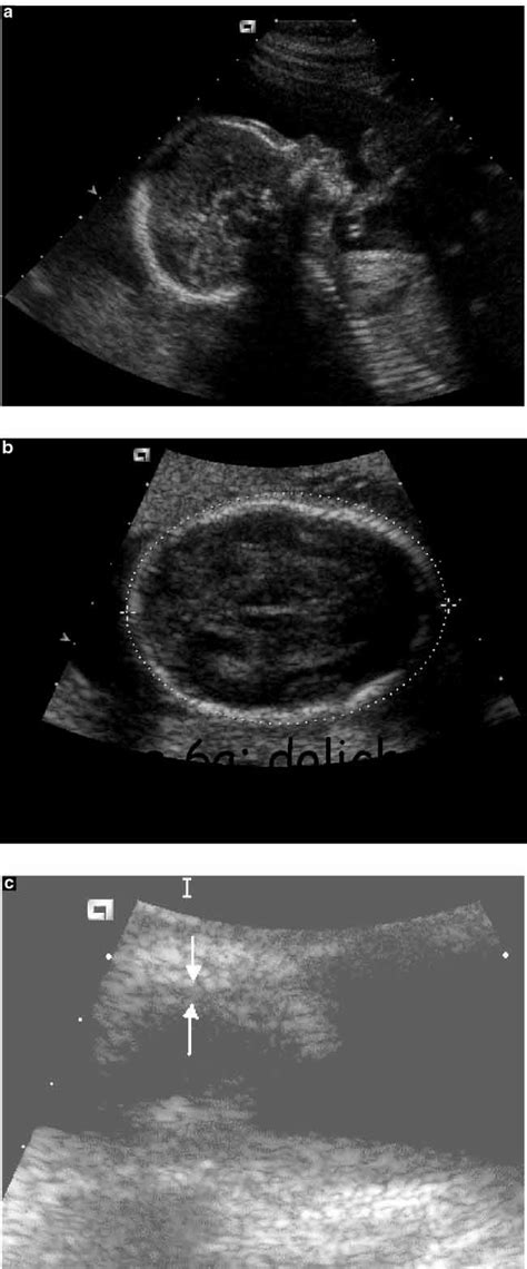 Prenatal Ultrasound Diagnosis Of Fetal Craniosynostosis Delahaye