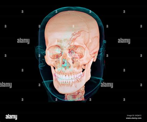 Fractured Skull 3d Ct Scan Stock Photo Alamy