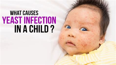 What Causes Yeast Infection In A Child Skin Infections Fungal