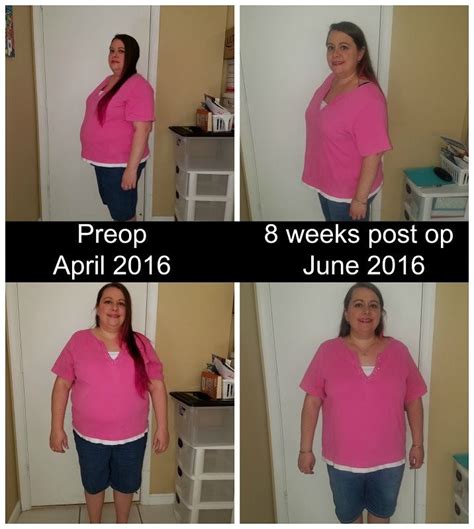 2 Month Post Op Gastric Sleeve Update Including What Im Eating Now