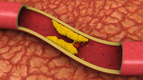 Symptoms Of Peripheral Arterial Disease The Vein Center Of Maryland