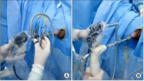 Hand Manipulation For Holmium Laser Enucleation Of The Prostate A Download Scientific
