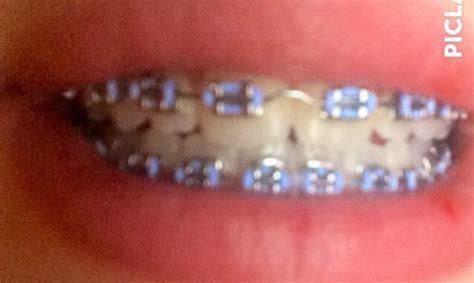 Pin On Braces