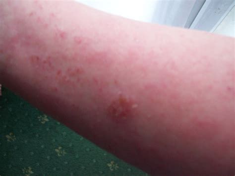 Skin Rashes On Forearms Pictures Photos