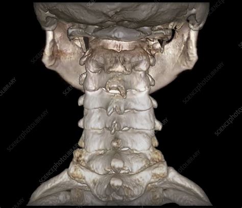 Human Cervical Spine 3d Ct Scan Stock Image C0388738 Science