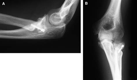 Peg In Socket Nonunion Of The Radial Neck Case Report And Review Of