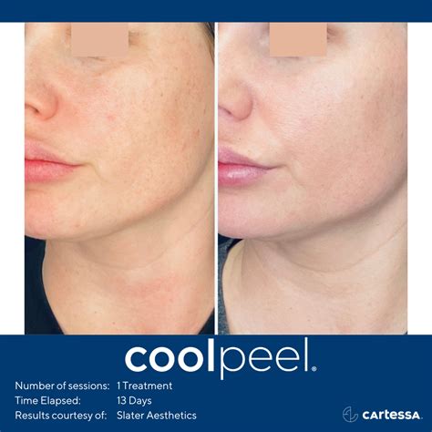 Cool Peel Co Laser Resurfacing The Skin Spot Laser Club Cape Coral