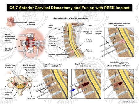 C Anterior Cervical Discectomy And Fusion With Peek Implant