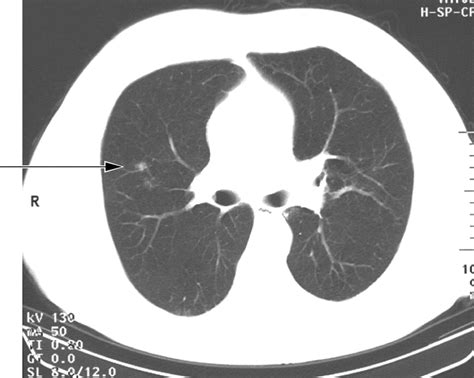 Screening For Lung Cancer Using Low Dose Ct Scanning Thorax