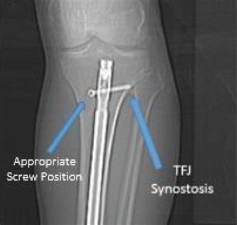 Proximal Tibiofibular Joint Synostosis A Ap X Ray Of The Left