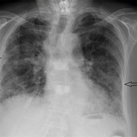 Chest X Ray Arrows Showing Diffuse Interstitial Opacity Download