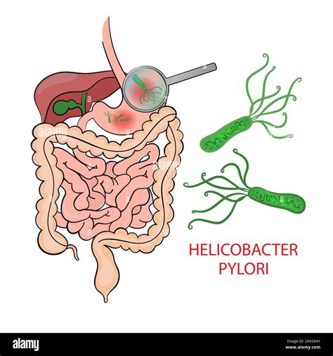 Helicobacter Pylori Diagrama De Educación En Medicina Esquema Vectorial Enfermedad Humana