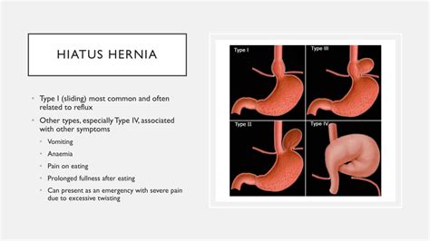 Ppt Reflux And Hiatus Hernias Powerpoint Presentation Free Download