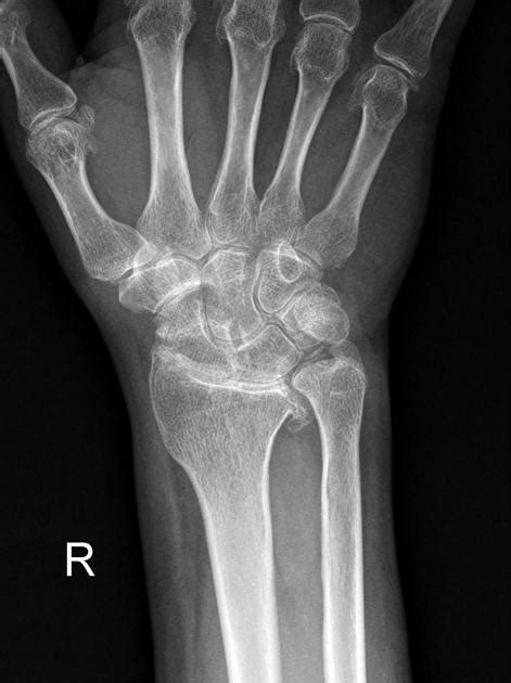 Chondrocalcinosis Hand And Wrist Radiology Case