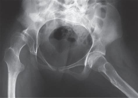 Cerebral Palsy Hip Conditions Pediatrics Orthobullets