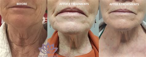 Neck Tightening Before And After Revive Laser And Skin Clinic