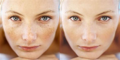 How To Prevent Freckles Skin We Are In