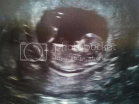 My 12 Week Ultrasound Any Nub Theory Gender Guesses