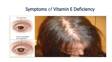 Vitamin E Deficiency Symptoms Skin Naturalskins