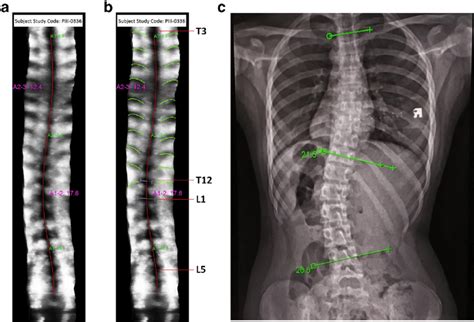 A An Ultrasound Volume Projection Image Of The Spine Showing Line Of