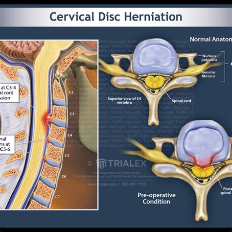 Cervical Disc Herniation And Cervical Radiculopathy D