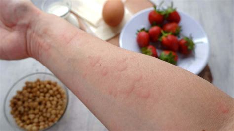 What Do Food Allergy Symptoms Look Like Chacko Allergy