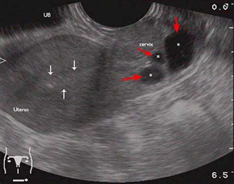 Nabothian Cyst In Cervix Causes Symptoms And Nabothian Cyst Treatment