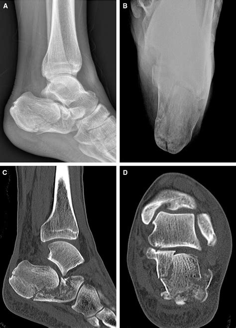 The Sinus Tarsi Approach In Displaced Intra Articular Calcaneal