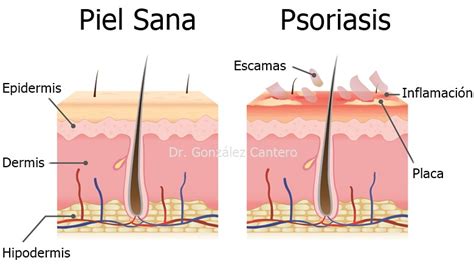 psoriasis qué es causas principales tipos y cómo puede tratarse