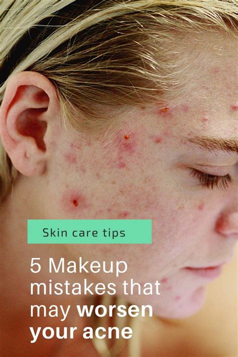 Acne Skin 5 Makeup Mistakes That May Worsen Your Acne