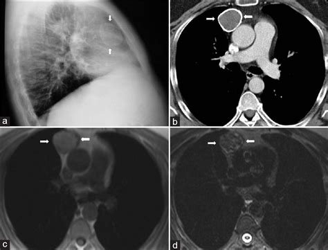 Imaging Of Cystic And Cyst Like Lesions Of The Mediastinum With