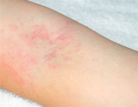 Types Of Rashes On Skin Images And Photos Finder