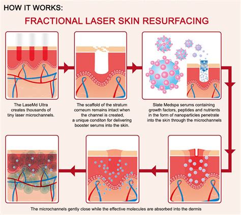 Laser Skin Resurfacing New Jersey Slate Medspa