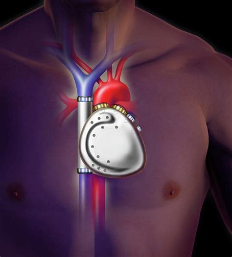 Mechanical Heart Pump In A Human Body Photograph By David Ford