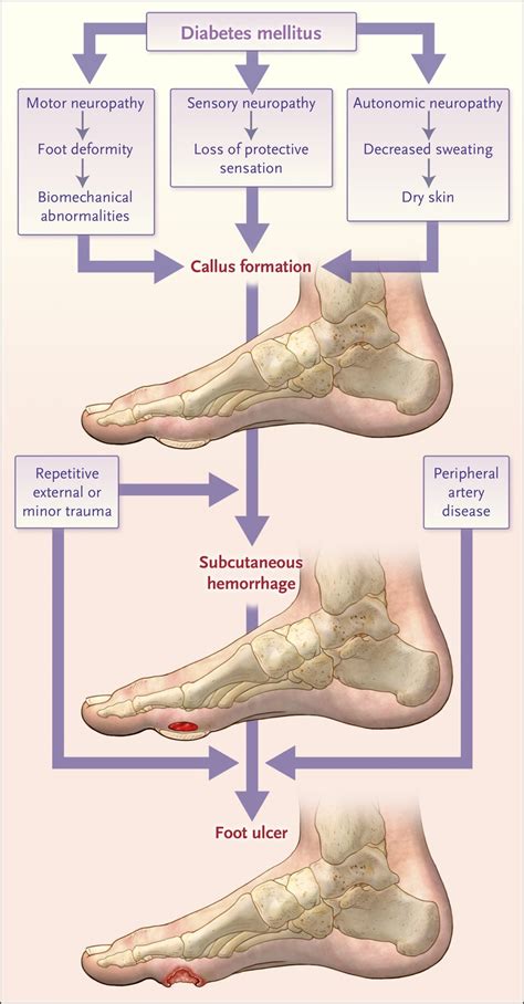 Diabetic Foot Ulcers And Their Recurrence Nejm