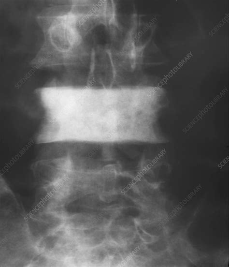 Secondary Bone Cancer X Ray Stock Image M1340547 Science Photo