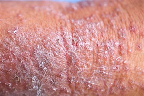High Patient Burden With Moderate To Severe Atopic Dermatitis