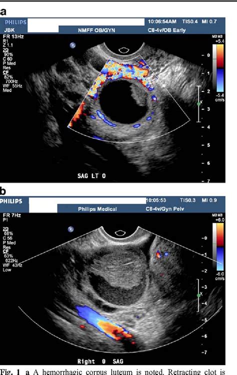 Transvaginal Ultrasound Assessment Of The Premenopausal Ovarian Mass