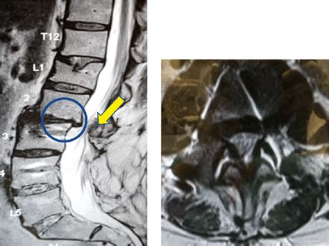 Patient One Pre Operative Mri T2w Sagittal And Axial Views Showing The